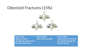 Odontoid Fractures (15%)
type I (<5%)
-oblique fracture
-through the upper part of
the odontoid process
type II (>60%)
-base of the odontoid
type III (30%)
-occurs when the fracture
line extends through the
body of the axis.
 