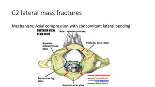 C2 lateral mass fractures
Mechanism: Axial compression with concomitant lateral bending
 