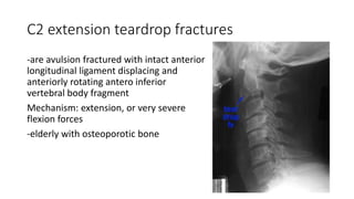 C2 extension teardrop fractures
-are avulsion fractured with intact anterior
longitudinal ligament displacing and
anteriorly rotating antero inferior
vertebral body fragment
Mechanism: extension, or very severe
flexion forces
-elderly with osteoporotic bone
 