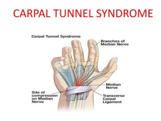 CARPAL TUNNEL SYNDROME
 