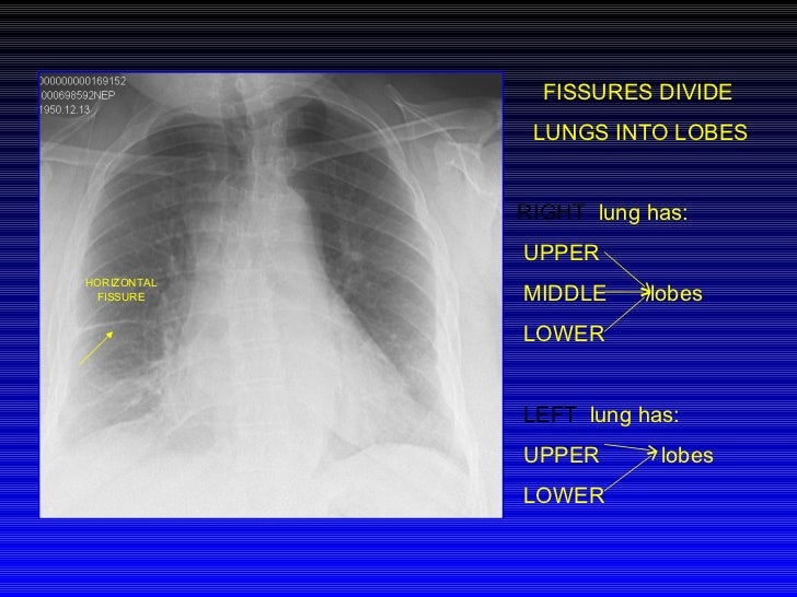 Chest Xray