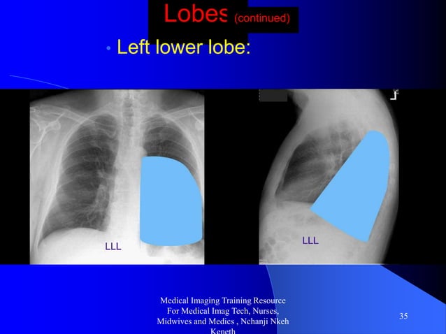 Chest x ray cxr and pathologies radiology training resource nchanji ...