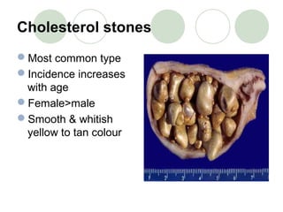 Cholesterol stones
Most common type
Incidence increases
with age
Female>male
Smooth & whitish
yellow to tan colour
 