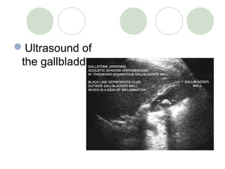 Ultrasound of
the gallbladder
 