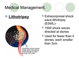 Medical Management.
Lithotripsy Extracorporeal shock
wave lithotripsy
(ESWL)-
1500 shock waves
directed at stones
Used for fewer than 4
stones, each smaller
than 3cm.
 