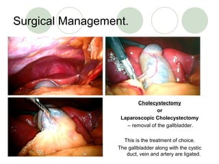 Surgical Management.
Cholecystectomy
or
Laparoscopic Cholecystectomy
– removal of the gallbladder.
This is the treatment of choice.
The gallbladder along with the cystic
duct, vein and artery are ligated.
 