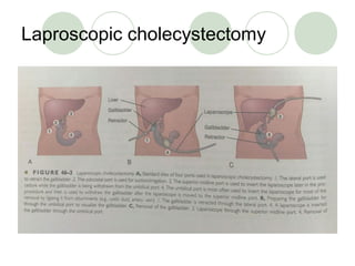 Laproscopic cholecystectomy
 