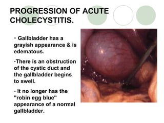 PROGRESSION OF ACUTE
CHOLECYSTITIS.
- Gallbladder has a
grayish appearance & is
edematous.
-There is an obstruction
of the cystic duct and
the gallbladder begins
to swell.
- It no longer has the
"robin egg blue"
appearance of a normal
gallbladder.
 