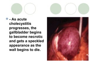 - As acute
cholecystitis
progresses, the
gallbladder begins
to become necrotic
and gets a speckled
appearance as the
wall begins to die.
 