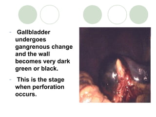 - Gallbladder
undergoes
gangrenous change
and the wall
becomes very dark
green or black.
- This is the stage
when perforation
occurs.
 