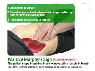 Cholecystitis cholelithiasis-presentation