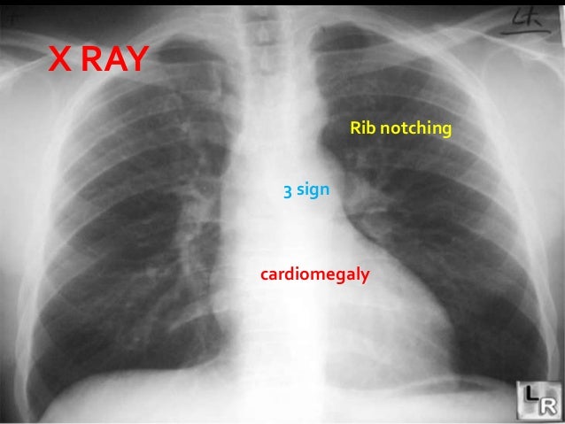 Coarctation of aorta