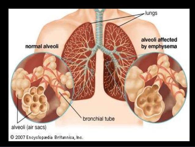 Cor pulmonale