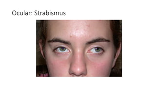 Ocular: Strabismus
 