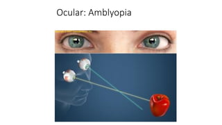 Ocular: Amblyopia
 