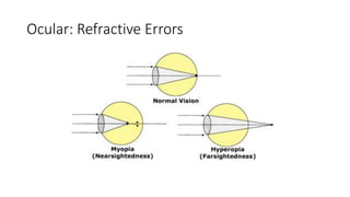 Ocular: Refractive Errors
 