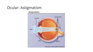 Ocular: Astigmatism
 