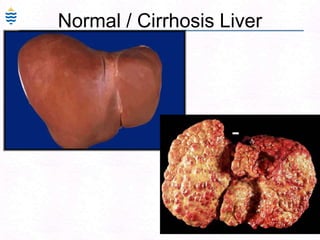 83Alcoholic Fatty Liver - collagen stain