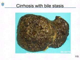 Alcoholic Hepatitis:86Centrilobular necrosis. Ballooned degenerating hepatocytes (BC) Mallory bodies (MB) Many Neutrophils, few lymphocytes & Macrophages. 