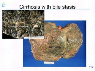 The central vein(or terminal hepatic venule (THV), is encased in connective tissue (C) (central sclerosis). Fat-laden hepatocytes (F) are evident in the lobule. The portal tract displays moderate chronic inflammation.87Alcoholic Liver Injury: ComplicationsPancreatitis – Acute or Chronic. Due to ischemic damage to pancreas.Alcoholic hepatitis – similar to viral hepatitis.Fulminant hepatitisAlcoholic Cirrhosis – Micronodular.Alcohol & Medical studentshttp://www.m-c-a.org.uk/about_us/about_mca