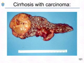 Patients either die in acute hepatic failure or recover without sequelae.Reye Syndrome:89Acute disease of children 