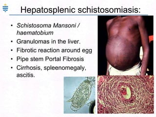 Uncommon, possibly as a result of decreasing use of aspirin in children.Toxemia of Pregnancy:90Hypertension, proteinuria, edema and coagulation abnormalities (pre-eclampsia) and convulsions and coma (eclampsia). 