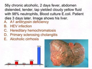 104Pathogenesis of Ascitis:Hepatorenal Syndrome