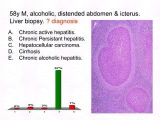 105Cirrhosis – Portal hypertensionCirrhosis-obstructionPortal hypertensionSplenomegalytransudation - Ascites