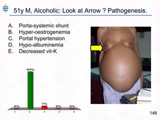 106Causes of Portal Hypertension: