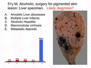 107Ascitis in Cirrhosis