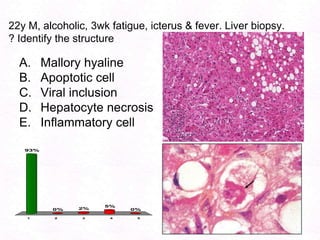 109Ascitis in Cirrhosis