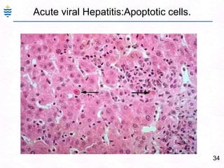 Hypogonadism