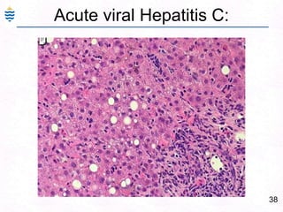 Ascites