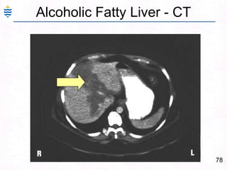 49Fulminant Hepatitis: