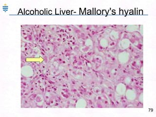 50Fulminant Hepatitis: