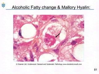 52Fulminant Hepatitis:confluent necrosis().