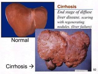 63Chronic Alcoholism:Clinical Features: