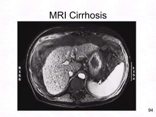 65Alcoholic Liver Injury: PathogenesisAcetaldehyde – metabolite – hepatotoxicDiversion of metabolism to alcohol Fat  storage – fatty change. Cell swelling..Rupture Fat necrosis  severe inflammation  fibrosis.Alcohol stimulates collagen synthesisInflammation, Portal bridging fibrosisMicronodular cirrhosis.