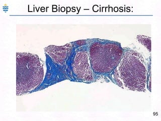 66Alcoholic Liver DamageIto Cells