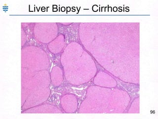 67Alcoholic Liver Injury: PathogenesisDiversion of fat metabolism to alcohol – fat  storage.Acetaldehyde – hepatotoxic – denatures ProteinsIncreased peripheral release of fatty acids.Alcohol stimulates collagen synthesisMutant ALDH2 gene with low activity enzyme is observed in Caucasians but is found in some 40% of Orientals (autosomal dominant).Acetaldehyde