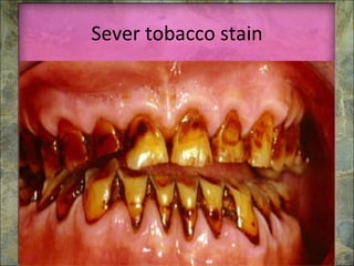 Sever tobacco stain 