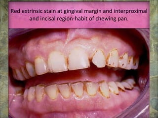 Red extrinsic stain at gingival margin and interproximal and incisal region-habit of chewing pan. 