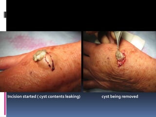 Incision started ( cyst contents leaking)   cyst being removed
 