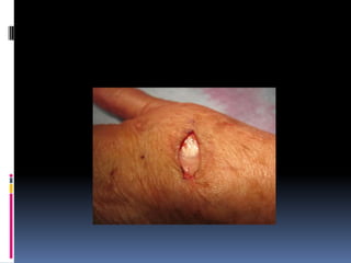 Dermoid cyst