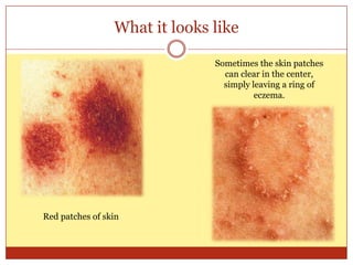 Discoid eczema | PPT image.