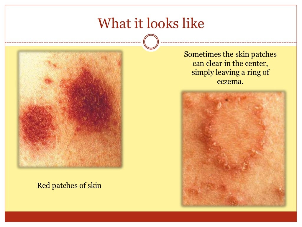 Discoid eczema