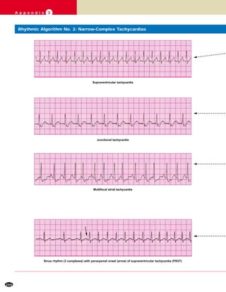 266
A p p e n d i x 3
Supraventricular tachycardia
Junctional tachycardia
Multifocal atrial tachycardia
Sinus rhythm (3 complexes) with paroxysmal onset (arrow) of supraventricular tachycardia (PSVT)
Rhythmic Algorithm No. 2: Narrow-Complex Tachycardias
 