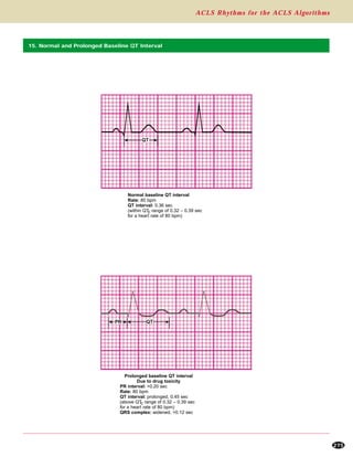 ACLS Rhythms for the ACLS Algorithms
275
QT
PR QT
15. Normal and Prolonged Baseline QT Interval
Normal baseline QT interval
Rate: 80 bpm
QT interval: 0.36 sec
(within QTc range of 0.32 – 0.39 sec
for a heart rate of 80 bpm)
Prolonged baseline QT interval
Due to drug toxicity
PR interval: >0.20 sec
Rate: 80 bpm
QT interval: prolonged, 0.45 sec
(above QTc range of 0.32 – 0.39 sec
for a heart rate of 80 bpm)
QRS complex: widened, >0.12 sec
 