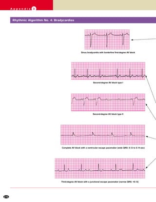 276
A p p e n d i x 3
Sinus bradycardia with borderline first-degree AV block
Second-degree AV block type I
Second-degree AV block type II
Complete AV block with a ventricular escape pacemaker (wide QRS: 0.12 to 0.14 sec)
Third-degree AV block with a junctional escape pacemaker (narrow QRS: <0.12)
Rhythmic Algorithm No. 4: Bradycardias
 