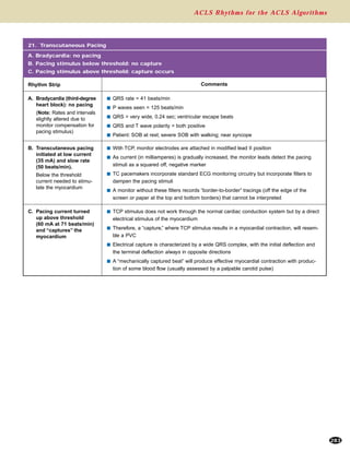 ACLS Rhythms for the ACLS Algorithms
283
C. Pacing current turned
up above threshold
(60 mA at 71 beats/min)
and “captures” the
myocardium
A. Bradycardia (third-degree
heart block): no pacing
(Note: Rates and intervals
slightly altered due to
monitor compensation for
pacing stimulus)
B. Transcutaneous pacing
initiated at low current
(35 mA) and slow rate
(50 beats/min).
Below the threshold
current needed to stimu-
late the myocardium
21. Transcutaneous Pacing
A. Bradycardia: no pacing
B. Pacing stimulus below threshold: no capture
C. Pacing stimulus above threshold: capture occurs
s With TCP, monitor electrodes are attached in modified lead II position
s As current (in milliamperes) is gradually increased, the monitor leads detect the pacing
stimuli as a squared off, negative marker
s TC pacemakers incorporate standard ECG monitoring circuitry but incorporate filters to
dampen the pacing stimuli
s A monitor without these filters records “border-to-border” tracings (off the edge of the
screen or paper at the top and bottom borders) that cannot be interpreted
s QRS rate = 41 beats/min
s P waves seen = 125 beats/min
s QRS = very wide, 0.24 sec; ventricular escape beats
s QRS and T wave polarity = both positive
s Patient: SOB at rest; severe SOB with walking; near syncope
s TCP stimulus does not work through the normal cardiac conduction system but by a direct
electrical stimulus of the myocardium
s Therefore, a “capture,” where TCP stimulus results in a myocardial contraction, will resem-
ble a PVC
s Electrical capture is characterized by a wide QRS complex, with the initial deflection and
the terminal deflection always in opposite directions
s A “mechanically captured beat” will produce effective myocardial contraction with produc-
tion of some blood flow (usually assessed by a palpable carotid pulse)
Rhythm Strip Comments
 